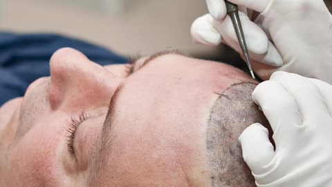 Hair Loss Treatment in Sarjapur Road – Sktruderma’s Advanced Solutions