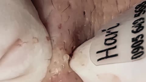 New satisfying blackhead removal #5