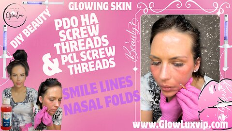 Smile lines & Nasal Folds PDO HA SCREW THREADS & PCL SCREW THREADS