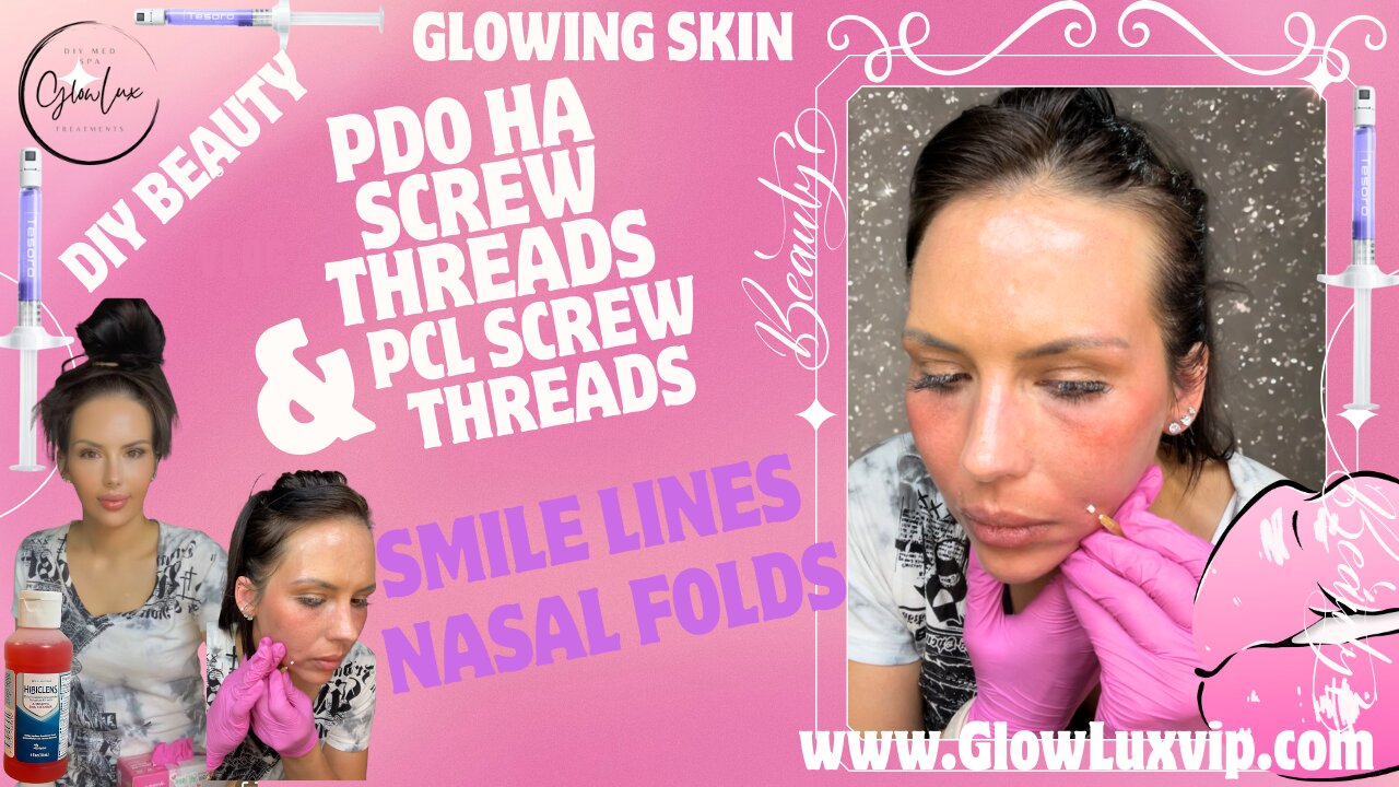 Smile lines & Nasal Folds PDO HA SCREW THREADS & PCL SCREW THREADS