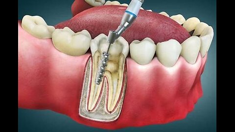 IS ROOT CANAL SAFE?