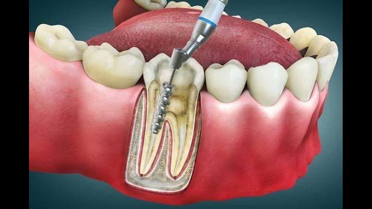 IS ROOT CANAL SAFE?
