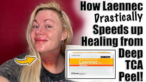 How Laennec Drastically Speeds up Healing from Deep TCA Peels! AceCosm.com and codeo Jessica10 Saves