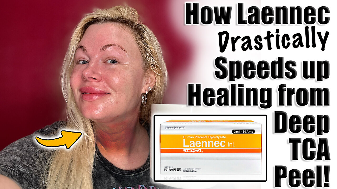 How Laennec Drastically Speeds up Healing from Deep TCA Peels! AceCosm.com and codeo Jessica10 Saves