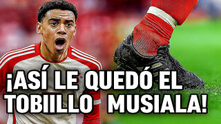 ⚠️ MUSIALA CON PERONÉ ROTO EN CUARTOS DEL MUNDIAL DE CLUBES VS PSG 😱