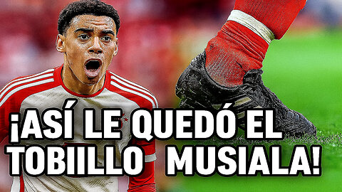 ⚠️ MUSIALA CON PERONÉ ROTO EN CUARTOS DEL MUNDIAL DE CLUBES VS PSG 😱