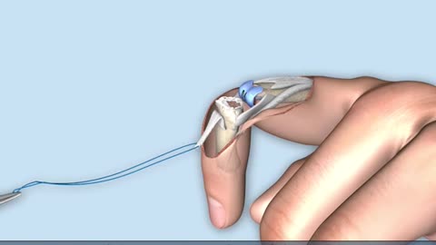 Finger Interphalangeal Joint Treatment 3D Animation