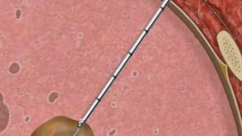 This Is How a Lung Cancer Biopsy Is Performed to Detect the Disease!