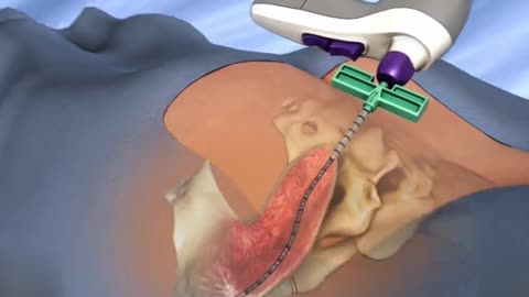Bone Marrow Harvest Procedure 3D Animation