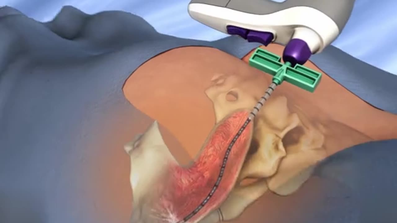 Bone Marrow Harvest Procedure 3D Animation