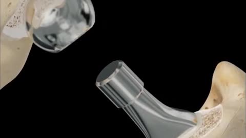 Hip Arthroplasty Surgery 3D Animaton