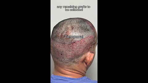 2,447 Grafts for Receding Hairline | FUE