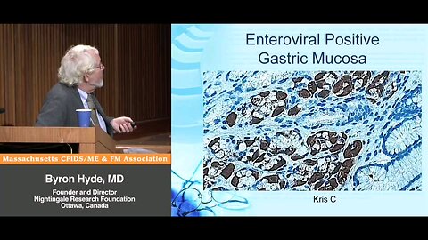 Dr. John Chia, Immuno-Peroxidase VP1 Gastric Staining for Enterovirus in Myalgic Encephalomyelitis (Enteroviral Encephalomyelitis) & "Original" Acute Onset Chronic Fatigue Syndrome (Enteroviral Encephalitis) Patients - Byron Hyde, MD