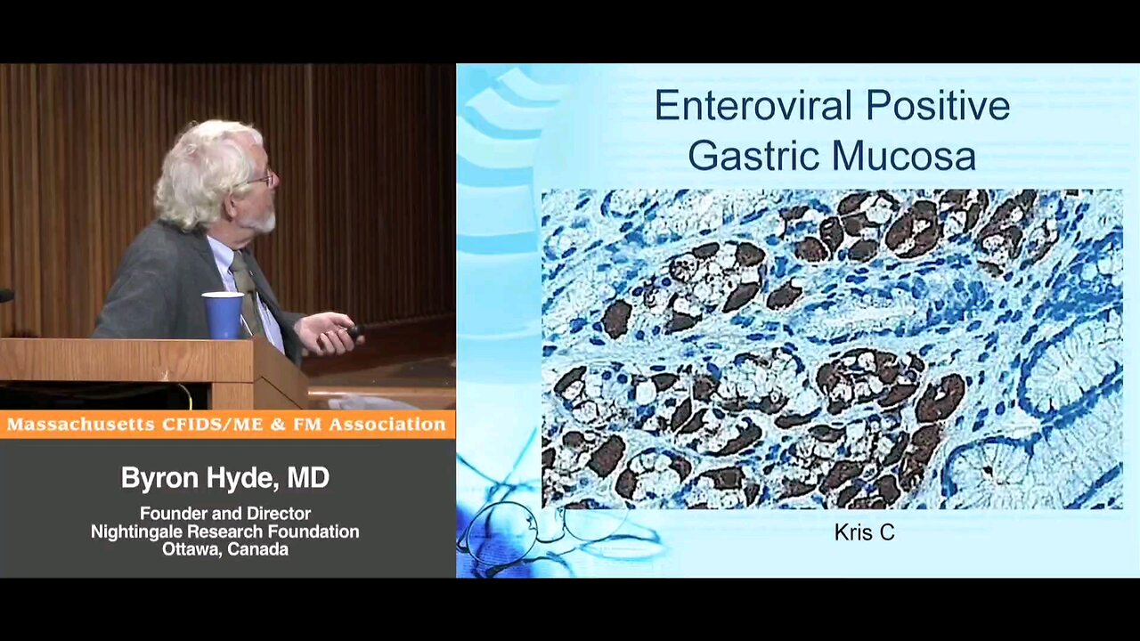 Dr. John Chia, Immuno-Peroxidase VP1 Gastric Staining for Enterovirus in Myalgic Encephalomyelitis (Enteroviral Encephalomyelitis) & "Original" Acute Onset Chronic Fatigue Syndrome (Enteroviral Encephalitis) Patients - Byron Hyde, MD