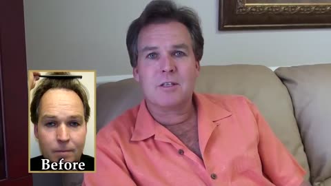 Dr. Brett Bolton Delivers Incredible Hair Transplant Results