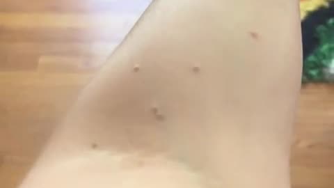 💀🤯 Wait Until You See the Infestation in This Paris Hotel Bed! | FunFM