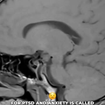 Measuring PTSD with Dr. Eugene Lipov