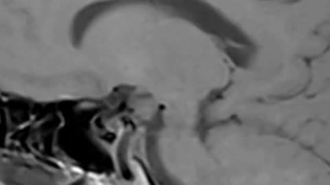 Measuring PTSD with Dr. Eugene Lipov