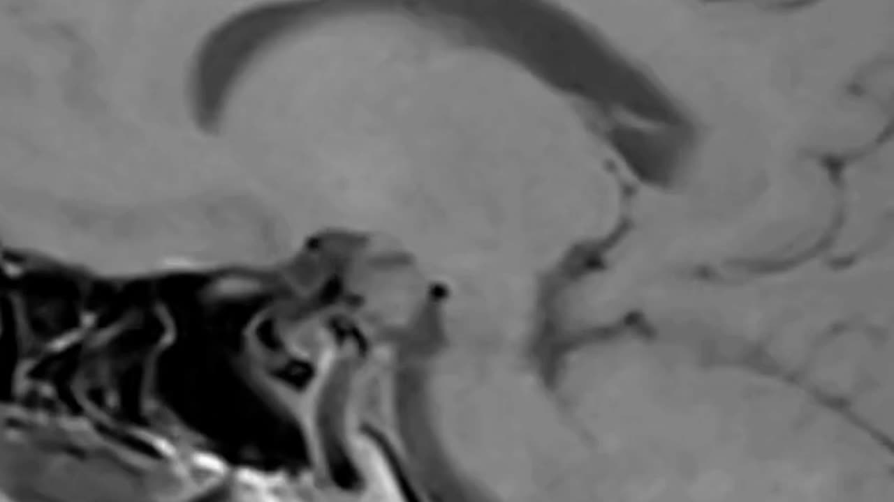 Measuring PTSD with Dr. Eugene Lipov