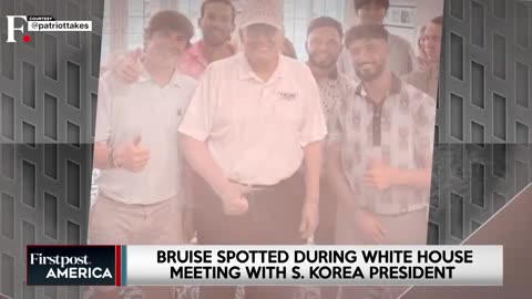 Trumps Hand Bruise Goes Viral Again, Internet Users Point To Heart Disease - Firstpost America