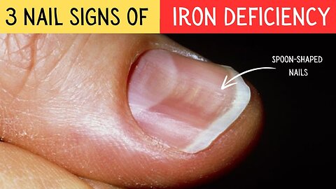 3 Nail Signs Of Iron Deficiency Anemia |MD14