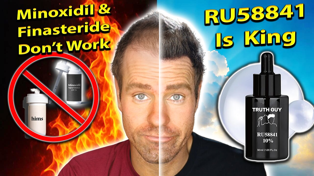 RU58841 is the BEST Hair Loss Product Ever! DHT Blocker