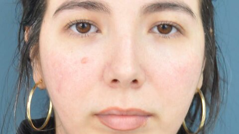 Rhinoplasty Refined