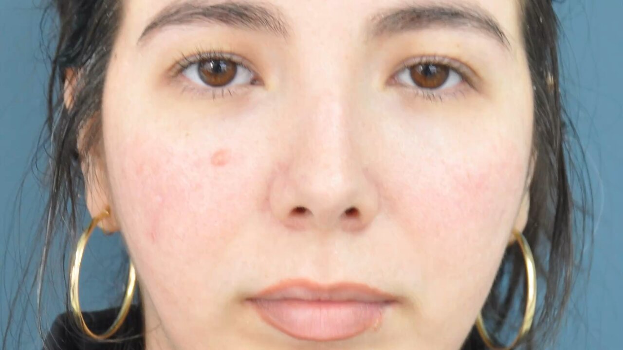 Rhinoplasty Refined