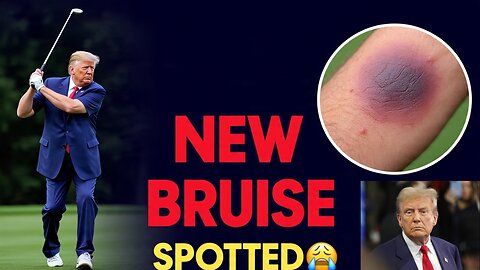 President Trump, 79, Spotted with NEW Hand Bruise | Health Concerns Mount