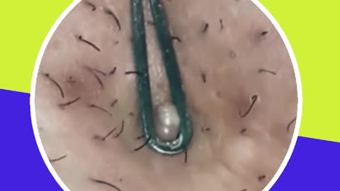Pimple removal satisfying video (ASMR) #21 #shorts