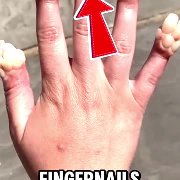 Human Nails Covered in Teeth!