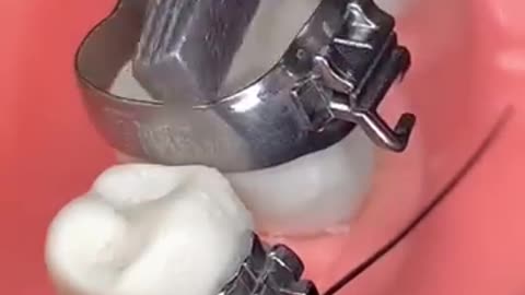 Shocking: Ranking The Most Satisfying Ice BreaksAmazing: BRACES , ORTHODONTICS