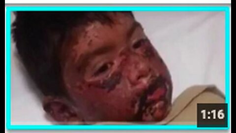 "8-Year-Old Boy Experiences Severe Injuries Following Pfizer Vaccine"