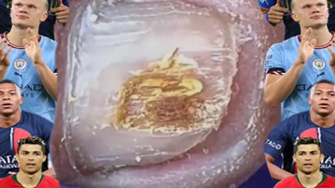 Ingrown Toenail Removal 2025 #ingrowntoenail #toenails #ingrown (24)