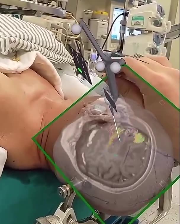 Surgeons use augmented reality and tractography to visualize the brain in real time