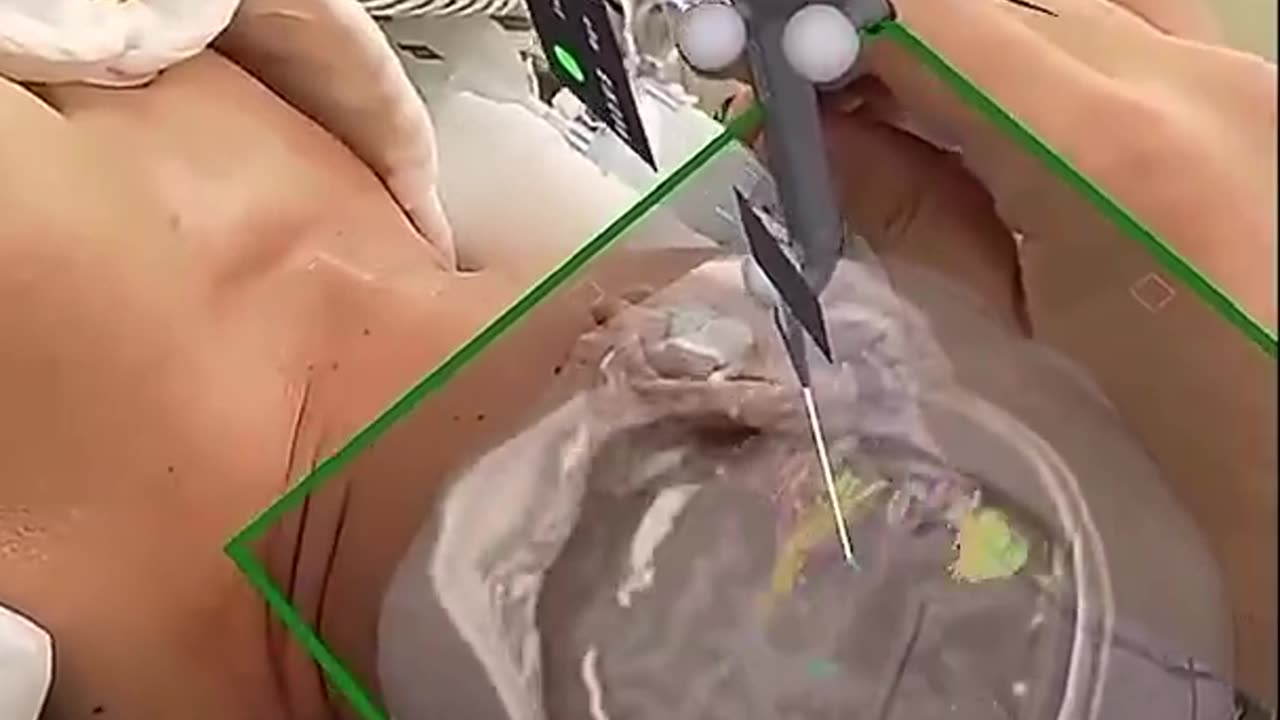 Surgeons use augmented reality and tractography to visualize the brain in real time