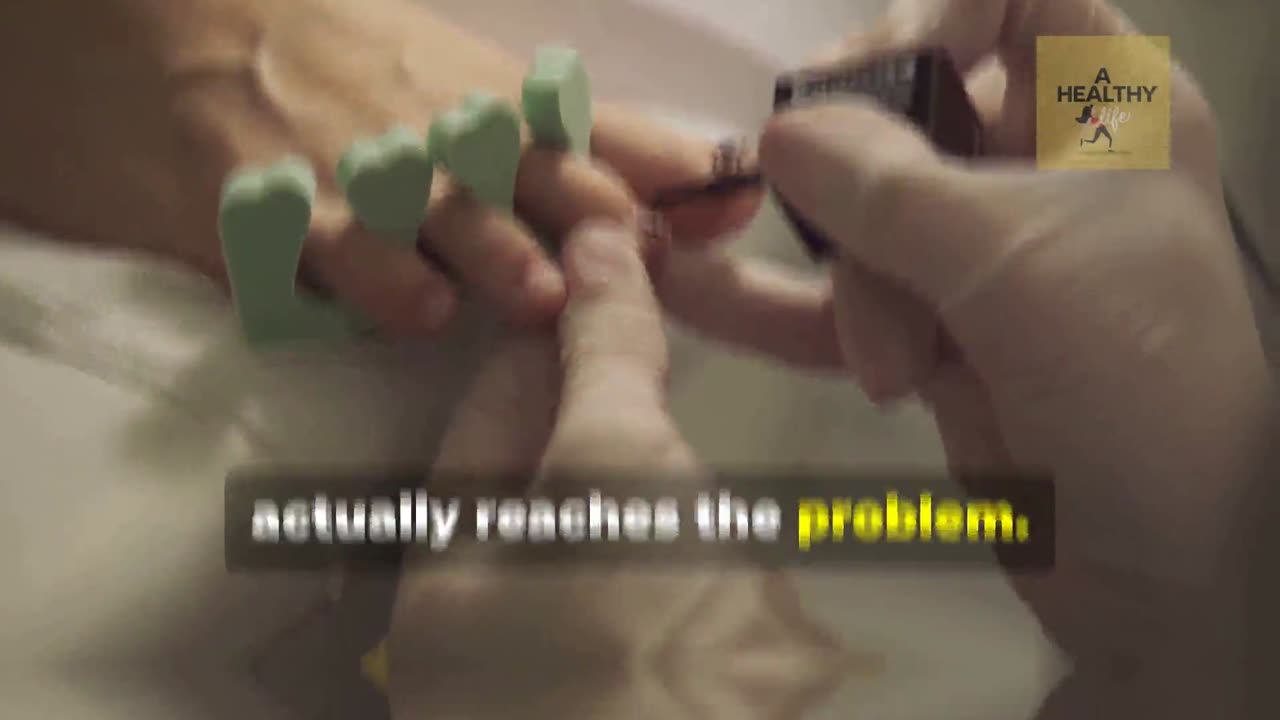 Fix Your Toenail Fungus with Metanail Serum Pro