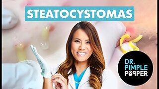 60 Minutes of Steatocystomas That Altered My Brain Chemistry