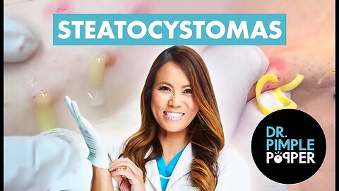 60 Minutes of Steatocystomas That Altered My Brain Chemistry
