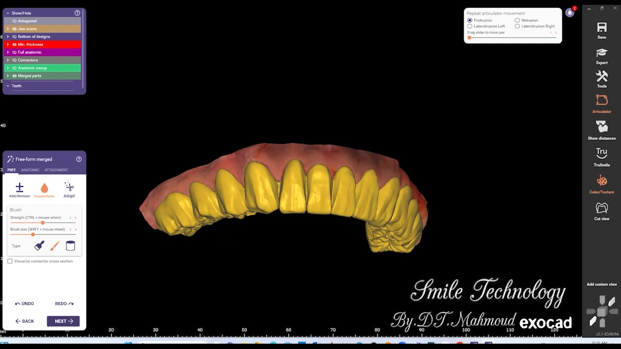 #design #naildesign #dental #dentaldesign #exocadexpert