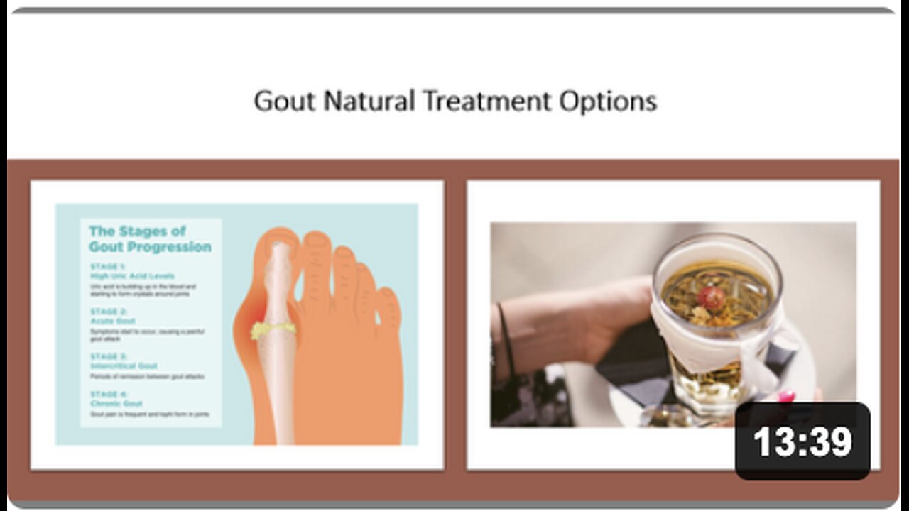 Gout - Natural Treatment Options