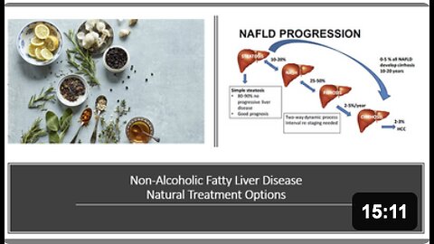 Non Alcoholic Fatty Liver Disease - Natural Treatment