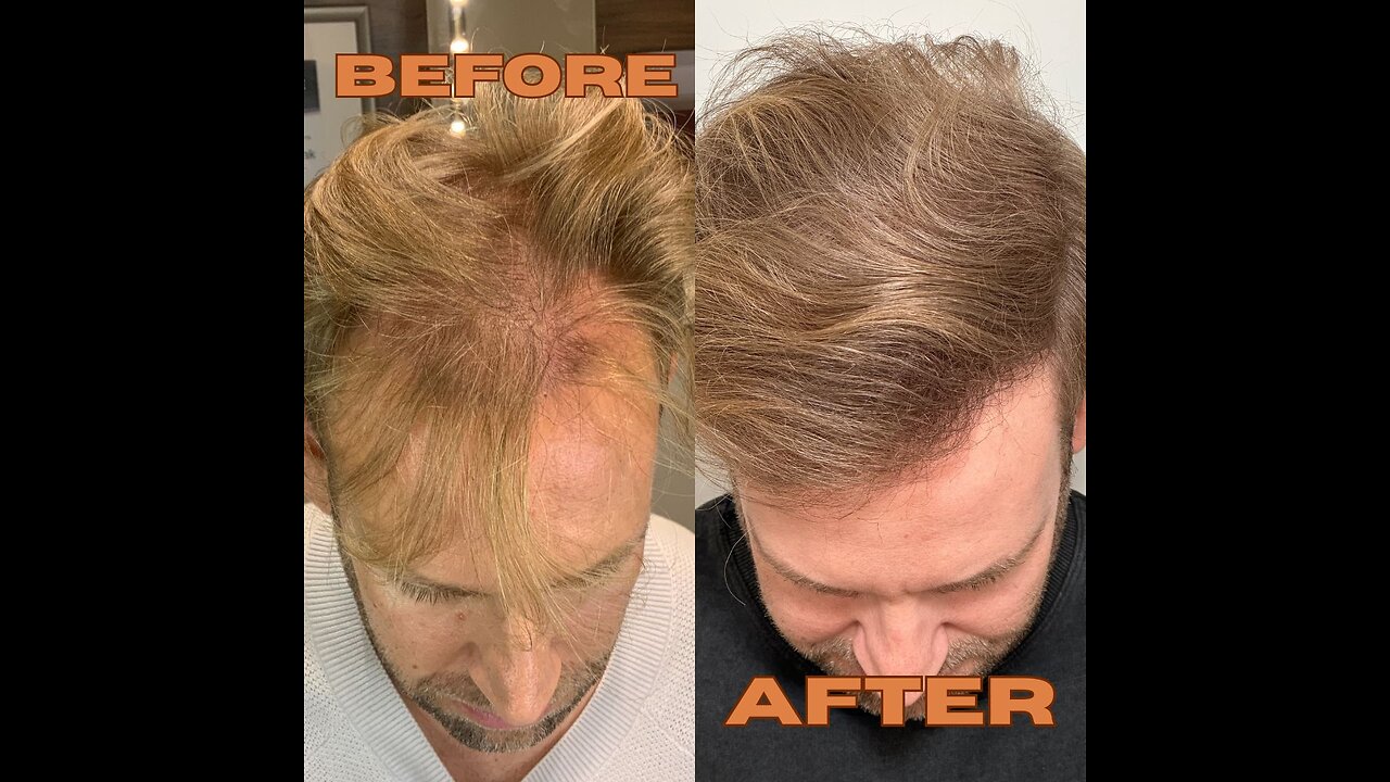 Hear about Sebastian's hair restoration experience!