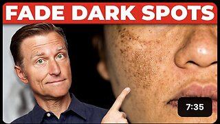Best Remedy for Hyperpigmentation