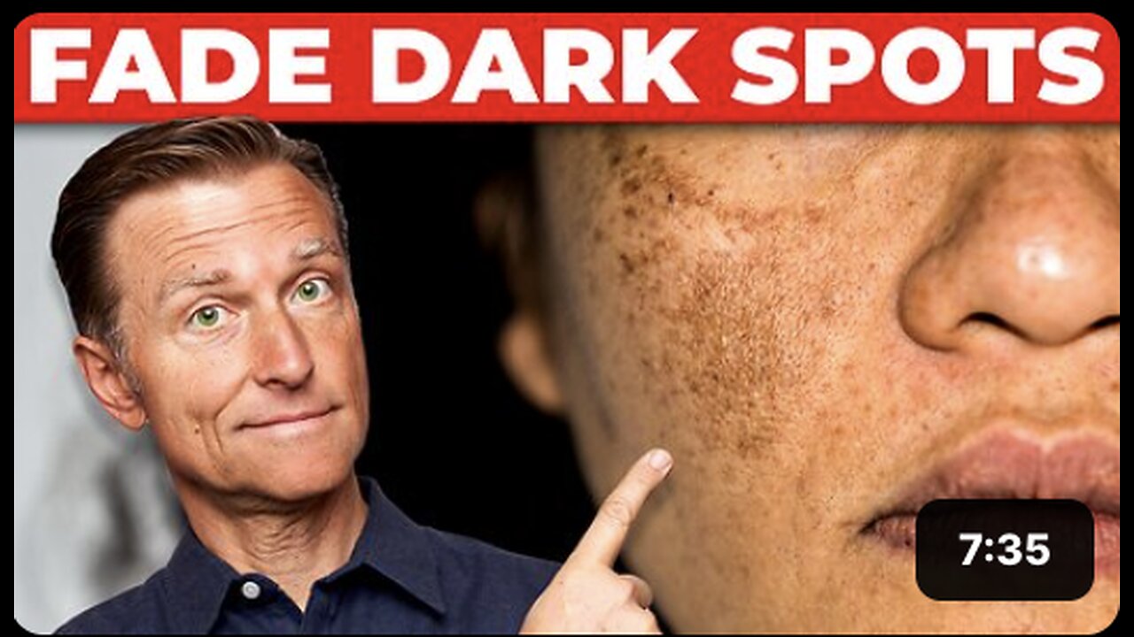 Best Remedy for Hyperpigmentation