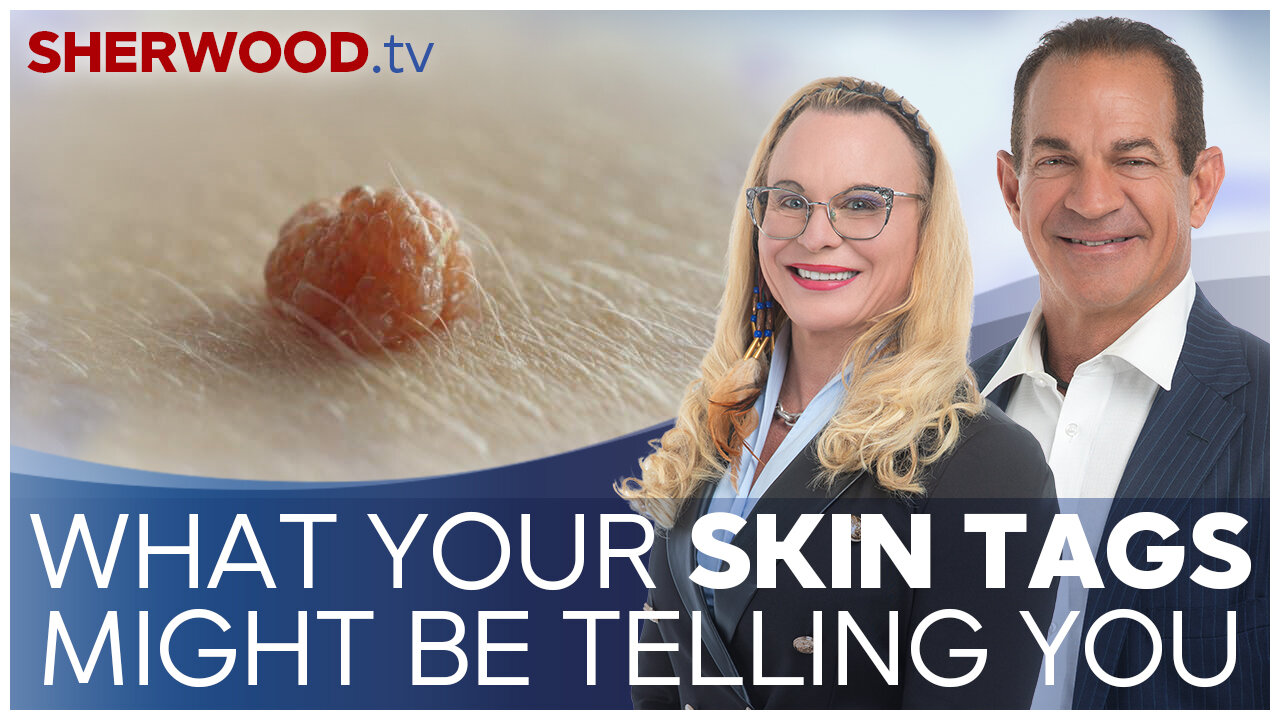 What Your Skin Tags Might Be Telling You