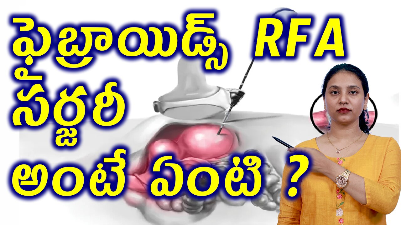 ఫైబ్రాయిడ్స్ RFA సర్జరీ అంటే ఏంటి? What is Fibroids Removal Surgery Radio Frequency Ablation?Homeo