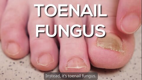Never Get Toenail Fungus(And How You Can Easily Use Their Hack To Get Rid of Any Stubborn Infection)