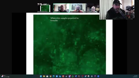 (CLIP) High Amyloidogenicity in Post-Mortem 'Calamari' Clots, Analyzing Clots Part 1