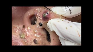 Blackheads Removal & Pimple Popper Cystic Acne Extraction 11